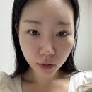 리즈멍 | 쥬베룩+리즈네 미라젯 후기 (멍, 붓기 없는 피부관리 솔직 리뷰)