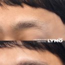 라이모플러스(LYMOPLUS) 네이버블로그