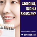 미사치과,치아미백 하면 연예인처럼 될까? 현실 결과 알려드립니다