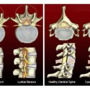 척추협착증(spinal stenosis)의 원인과 치료법 이미지