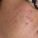 아침향기한의원 | 내돈내산 강남한의원 여드름흉터 새살침후기