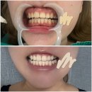 두리 하얀이치과의원 | 치과 치아미백 후기 치아미백 시림 음식