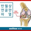 관절경수술잘하는곳/무릎연골수술/반월상연골판파열/관절내시경 이미지