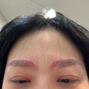 오라클피부과천안 | 천안눈썹문신제거 1개월차후기 #오라클피부과신부점