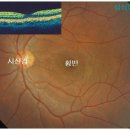 현대 의학에서 황반변성 이라합니다. 이미지