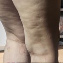 구피샵창원가음정점 | 창원하체부종관리 루미에르스킨라운지ㅣ부종 다리가 깃털처럼 가벼워진 후기