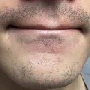 하얀피부과 | 하얀메디컬 피부과 레이저 제모 후기(사진 주의)