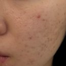 광덕안정한의원 | 구리시 스킨부스터 고주파 관리로 피부 관리 후기