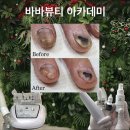 희망화원 | 대구 문제성손발톱전문 바바뷰티 아카데미ㅣ화원 무좀발톱 관리 50% 할인 이벤트