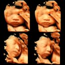 릴리브의원 | [임신 기록] ~31주/폭염 속 당근러/억지로 밥먹기/백일해 접종/ 미즈메디에서 이대서울 전원?!