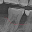 와이즈치과의원 | 잇몸뼈가 살아났습니다 – 이**님의 엠도게인 치료 후기 (서울와이즈치과)