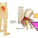 엉덩이 통증 이미지