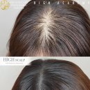 하이스칼프 이미지