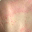 참약국(광명동물약국) | 만성 두드러기 일기 : 중앙대광명병원 방문