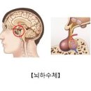 뇌하수체 종양 (선종) 말단비대증 &amp;거인증 이미지