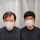 블랭크유전주반월점 | "20대 청년, 젊음이 아깝다면? 블랭크유 반월점 '12,000모 증모술'로 탈모 고민 끝!"