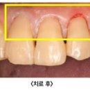 이가 시린이유 확인하고 솔루션 찾기 이미지