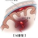 두통 심할때 의심 질환 이미지