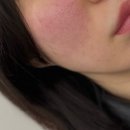 맥스 | 인천 구월동 리쥬란힐러 리쥬란맥스 후기 부작용 통증 유지기간