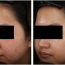 블랑여성의원 | 범계포텐자 모공 흉터 효과 어떨까? 논문에서는 이렇습니다