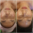 272-0506 | [공지] 봄맞이 이벤트 필링+LDM 물방울 리프팅