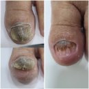 송탄베스트의원 | 조갑구만증 두꺼워지는 발톱 관리 후기 평택 송탄역 고덕신도시 문제성발톱 스케일링 무좀레이저 병원