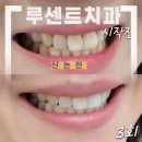 제우빌딩(미소의원) | 서울 신논현 루센트치과 치아 미백 전 후 차이와 관리 후기 및 주의사항