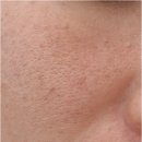 법대로 | 모공줄이는법 시술 내돈내산 허탈했던 후기