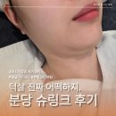 분당-30 | 분당슈링크 후기 30대 턱선 고민으로 알아본 서현리프팅