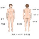 카르시노이드 증후군[Carcinoid syndrome]유방내분비질환, 종양혈액질환 이미지