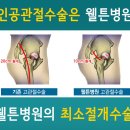 고관절 통증은 고관절 인공관절 수술로 해결하세요 이미지