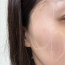 샘깊은약국 | 편평사마귀 제거 정자역피부과 싹뺀다 당일후기