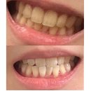 우리치아 치과기공소 | 강남 레브치과 치아미백 가격 , 솔직 후기 및 할인 정보