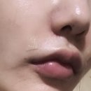 쌈짓돈2 | 20대가 맞아본 팔자주름 레디어스 콜라겐 필러 + Co2 레이저 내돈내산 후기