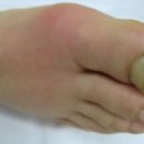 123..2025년 7월 13일..남자 울리는 통풍, 주범은 과일주스·탄산음료! 덥을때 맹물 마시는 것이 최고 입니다 이미지