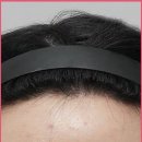 뮬리성형외과의원 | 이마축소 수술 후 3년 차 후기 (이마 넓어짐)