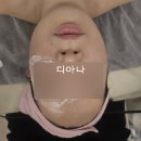 비채라인 | 익산 웨딩관리 비채뷰티 알테온리프팅 후기