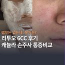 튼튼드림의원 | 리투오 후기 ㅣ 급부상한 스킨부스터 6cc 캐뉼라 손주사 둘 다 맞은 솔직리뷰 (+멍, 붓기, 다운타임)
