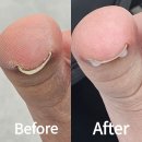 이수로 | 순천 내성발톱 교정 문제성 발톱 전문 더네일푸스 무통증 관리 솔직후기