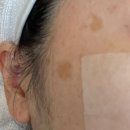 봄스피부과의원 | (내돈내산) 봄스피부과