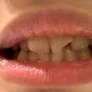 반월치과의원 | 중학생 교정은, 대구 배성민 교정치과 후기