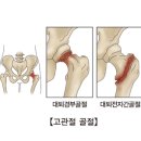 고(股)관절 - 엉덩이(넓적다리) 관절(關節) 이미지