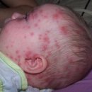 수두 (Varicella (Chickenpox)) 이미지