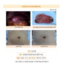 담석증수술후기. 건강검진으로 1.5cm 담석이 하나 있고, 담낭벽 비후가 있음을 발견했어요. 이미지