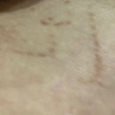 이노유지 | 이노테이프사용후기(제왕절개흉터관리/민감성피부/육아템/방수용의료테이프)