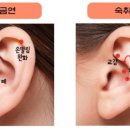 귀건강(이혈테라피) 이미지