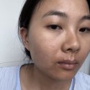피코토닝 효과 보다 좋았던 장희빈미안법 후기