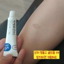 유일프라자약국 | 상처 멍들고 곪았을 때 방치하면 위험, 피부과 병원 치료 후기 및 비용