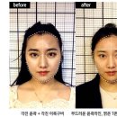 효창목5길 1 | 리얼후기-얼굴이 작아지고 윤곽라인이 부드러워 졌어요~!