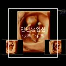 11650-16-173-5 | 연년생 임신 12주 16주 초음파 성별 1차 2차 기형아검사 검사항목 비용